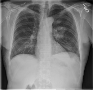 Single frontal chest radiograph demonstrating a  moderate sized left pneumothorax. A left hilar cavitating ground glass opacity and an additional anterior left upper lobe ground glass opacity are seen. 