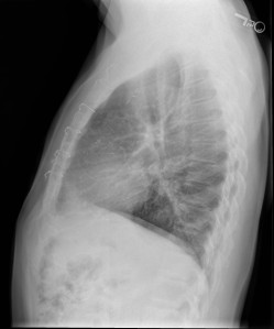 Lateral chest radiograph in a male patient with a history of CABG with LIMA. The sternotomy wires and vascular clips are visualized. 