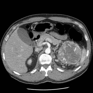 Single axial CT scan with IV contrast through the abdomen in arterial phase at the level of the pancreas reveals a large enhancing left kidney mass with areas of central necrosis. 