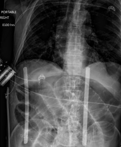 Single frontal radiograph of the upper abdomen shows free intraperitoneal air, as evidenced by the conspicuous outline of the small bowel walls (Rigler Sign)