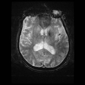 Single axial T2*-weighted GRE MR image through the brain shows a focus of susceptibility (the susceptibility vessel sign) in the left middle cerebral artery.