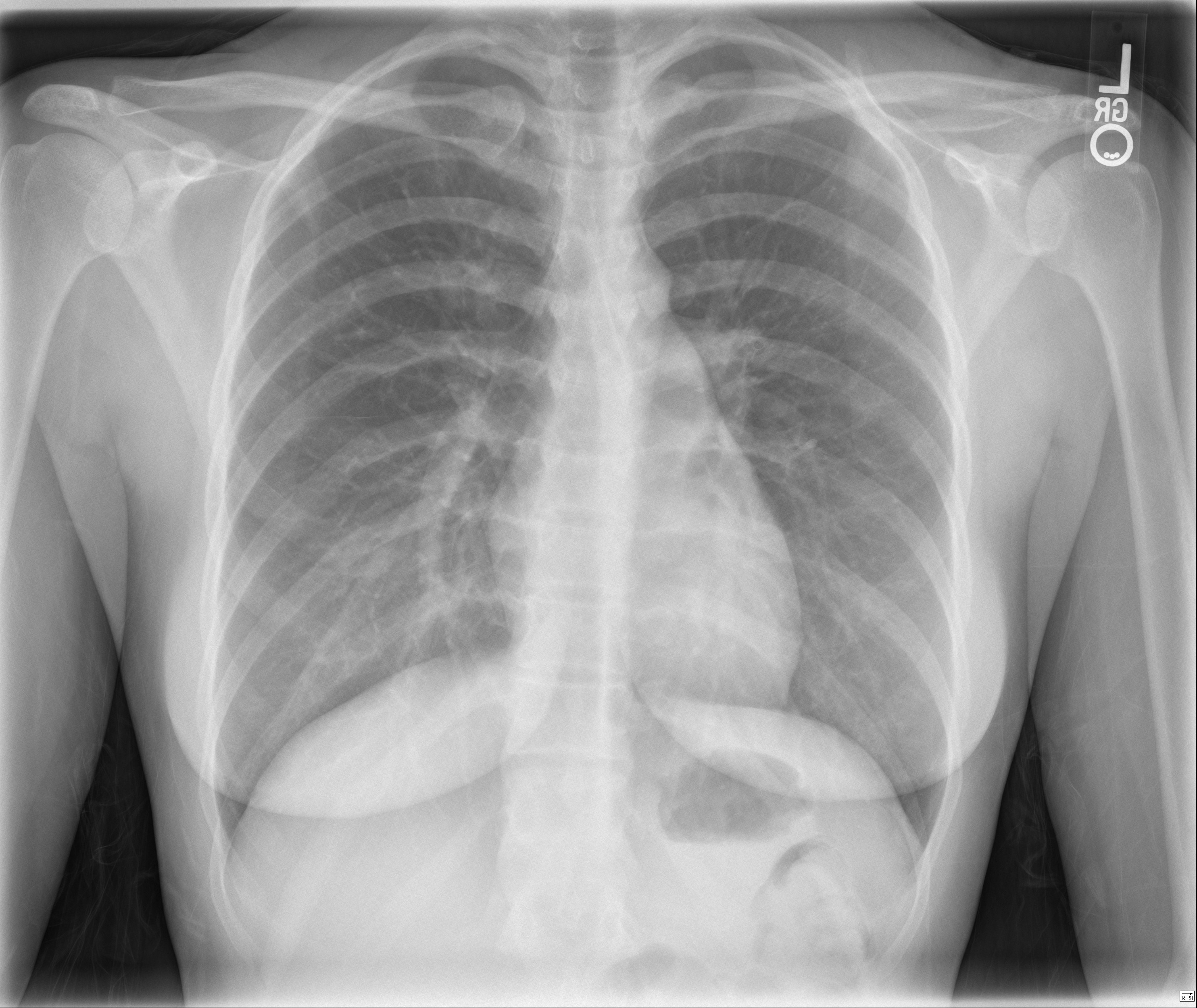 Normal Female Chest Radiograph –