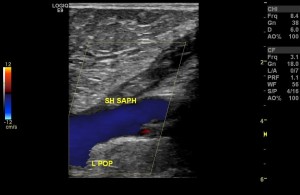 Superficial Venous Thrombus: Sagittal ultrasound of the left calf in the same patient at the junction of the short saphenous and popliteal vein again shows completely occlusive clot with no flow in the short saphenous vein. Note, the popliteal vein is patent.