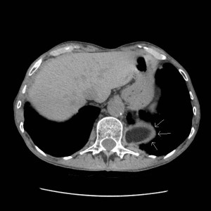 Axial CT of the lung bases shows abnormal herniation of abdominal fat contents into the lower posterior left hemithorax through the left hemidiaphragm.