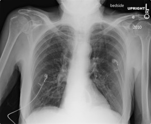 Frontal bedside radiograph of the chest shows a rounded opacity projecting right lateral to the right paratracheal stripe (arrow). 