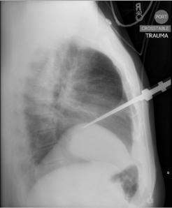 Lateral radiograph of the chest shows a knife entering the anterior thorax. It is difficult to further ascertain the position with only the lateral view. 