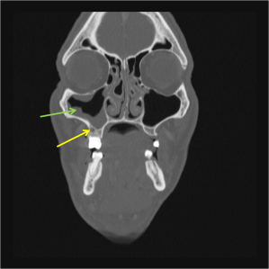 Coronal CT image of the face reveals a periapical lucency near one of the right maxillary molars (yellow arrow). Note the mucosal thickening in the right maxillary sinus as a result of the adjacent inflammation.