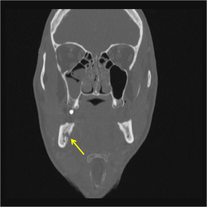 Coronal CT of the face in bone window shows a lucency in the right side of the mandible which erodes through the lingual cortex (yellow arrow).