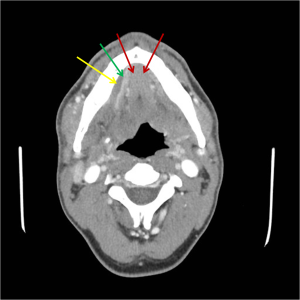 Axial CT of the neck with contrast reveals asymmetrical swelling and fluid collection in the right submandibular space (yellow arrow). The right mylohyoid muscle is enhancing and is labeled with the green arrow, and the genioglossus muscles are labeled with the red arrows.  