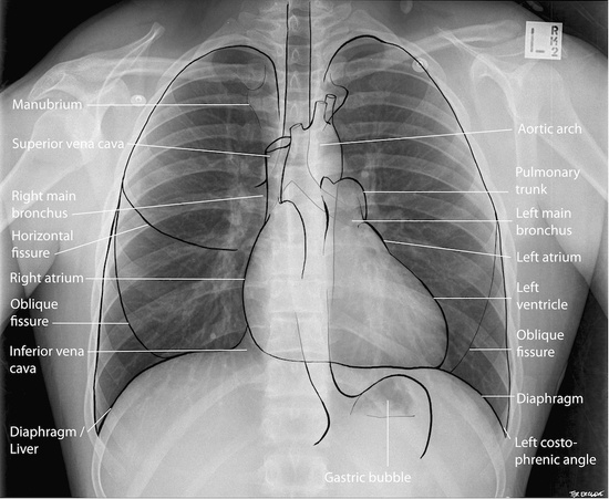 Anatomy Of A Chest X Ray Radiologypics Com