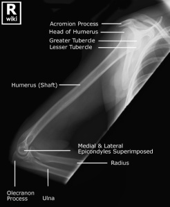 Lateral radiograph of the humerus with labels.