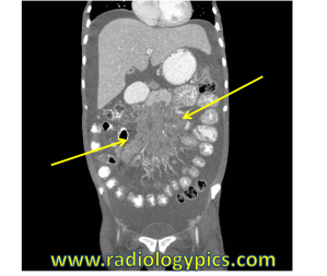 Mesenteric Lymphadenopathy: Coronal CT of the abdomen with contrast shows the large amount of soft tissue mass within the mesentery (between the yellow arrows), compatible with mesenteric lymphadenopathy. 