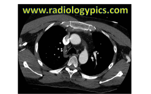 Axial CT scan of the chest with intravenous contrast. What are the findings?