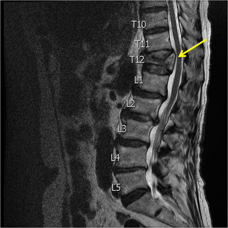 sagittal-t2-mr-thoracic-spine-compression-fracture Icd 10 For Compression Fracture