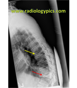Thoracic Spine Compression Fractures - Lateral radiograph of the thoracic spine reveals two severe compression fractures (yellow and red arrows) with complete anterior height loss and focal exaggerated kyphosis at the lower compression fracture (red arrow) 