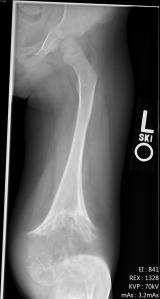 Frontal radiograph of the left knee at 3 years old 4 months.